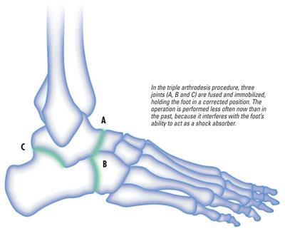 A- Talonavicular joint B- Calcaneocuboid joint C- Subtalar or Talocalcaneal joint What is hindfoot/ankle arthritis?