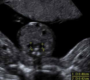 > 7mm - 32 weeks and greater Pyelectasis Antenatal Management Assess