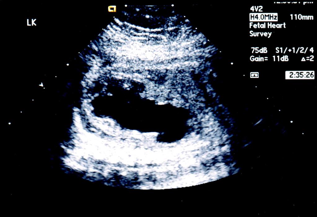 to severe hydronephrosis Dilated renal pelvis Dilated calyceal system Enlarged
