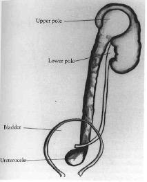 ectopic ureter (ureterocele) Lower pole drained by normotopic ureter