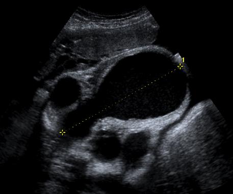 Posterior Urethral Valves Ultrasound Findings Best diagnostic clue = keyhole bladder Distended bladder funnels into dilated posterior urethra Ureteral, pelvis and calyceal dilation Cortical cysts -