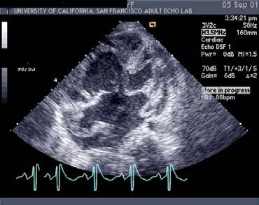 PA Systolic Pressure AV Septal Defect: Unoperated Cyanotic Heart Disease: Right to Left Shunt Cyanosis Eisenmenger s inoperable RVOT obstruction operable Heart