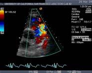 obstruction and insufficiency TR Residual VSD,
