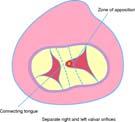 Atrioventricular Canal Defect (AKA: AV Septal Defect, Endocardial Cushion Defect) Large Primum ASD VSD Common
