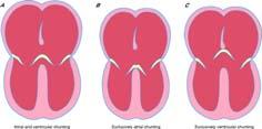 Heart 2006;92:1879-1885 1885 Level of shunting depends on attachment of bridging leaflets Ostium primum defect