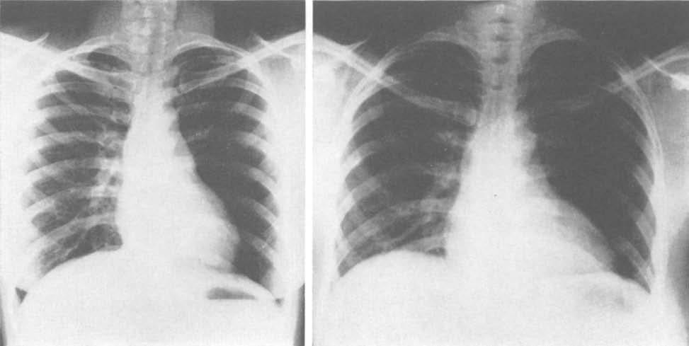 McNAMARA ET AL. A B FIG. 1. (A) Chest x-ray showing radiolucency of the left lung field with diminished vascular markings.