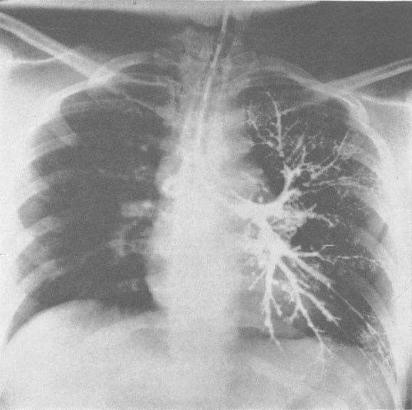 Pulmonary angiography revealed an abnormally small vessel to the left lower lobe, with diminished vascularity of that lobe (Fig. 3).