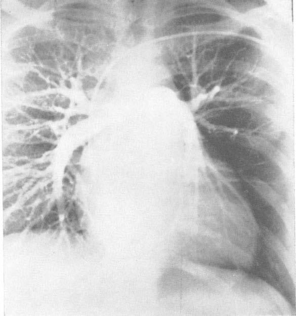 CASE REPORT: Idiopathic Unilateral Hyperlucent Lung FIG.?. Pulmonary angiography demonstrated apparent reduction in size and flow through the left lower lobe artery and its branches.