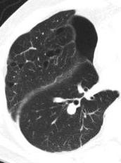 Birt-Hogg-Dube Syndrome Rare, autosomal dominant syndromes characterized by skin hamartomas, renal tumors (chromophobe RCC), pulmonary cysts (80-90%) Thin walled cysts Vary widely in size