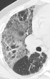 Desquamative Interstitial Pneumonitis (DIP) Strong association with smoking Small cysts (< 2cm) represent focal bronchiolectasis and dilated alveolar ducts Associated with patchy ground glass
