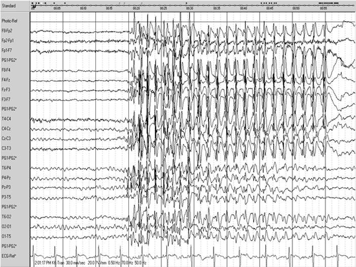 Absence seizure GTC myoclonic duration 4-30 sec (~16s) freq automatism,6-10 sec after EEG onset mild myoclonic of the eyelids absence status