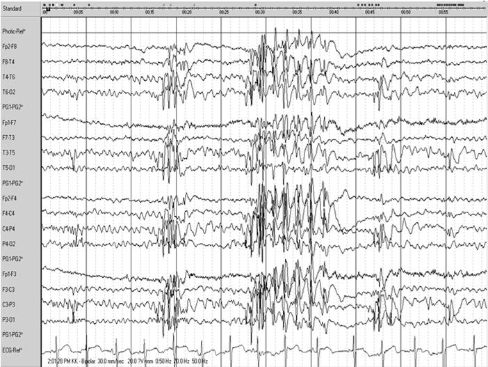associated with GTC after awakening or Ictal EEG myoclonic sz fast 10 16 Hz spikes