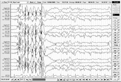 wave, last 1 4 sec if begin before 10 yrs-more severe JME EEG JME EEG Interictal EEG