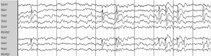 Interictal EEG in BRE Spike/wave discharges triphasic follow