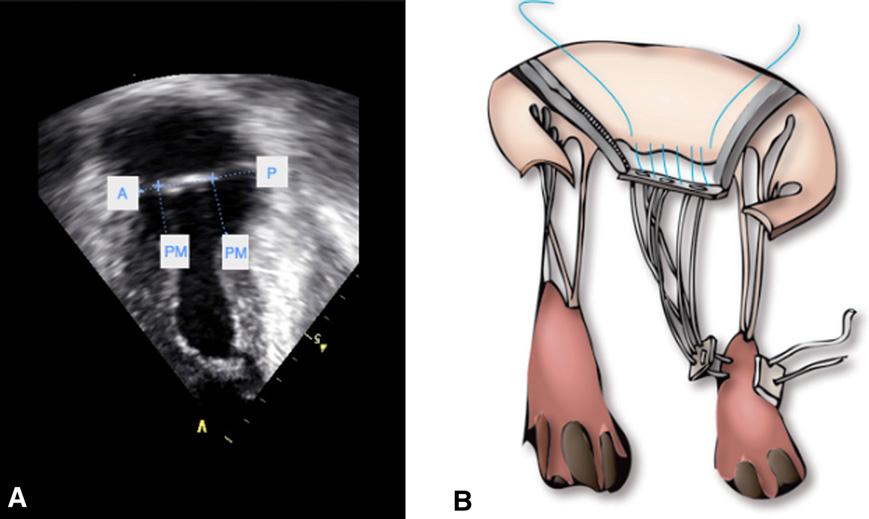 FIGURE 1. A, Preoperative echocardiogram measurements. A-P line, Annular plane; PM, papillary muscle. B, Parachute insertion. required reoperation 1 year after the initial procedure.