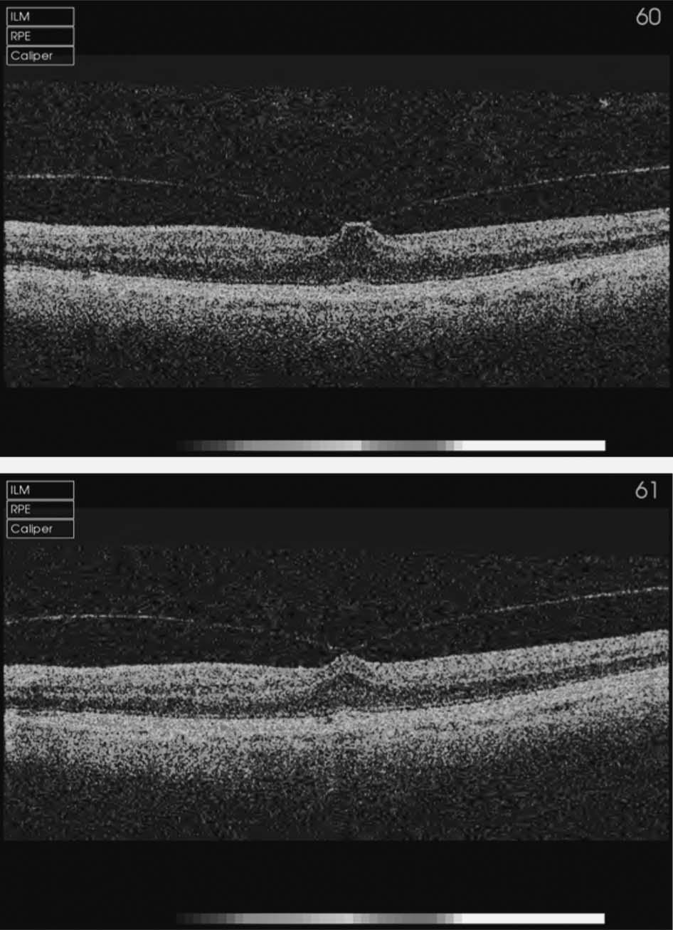 TRACTIONAL CYSTOID MACULAR EDEMA CHARALAMPIDOU ET AL 2049 Fig. 2. Patient 6. A. Optical coherence tomography of the left eye causing tractional cystoid foveal thickening. B.