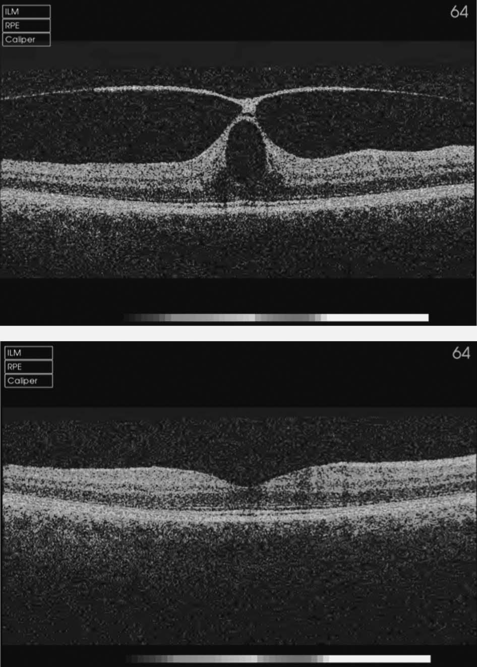 attenuation of the cystic changes at the fovea. VMT syndrome is typically.1,500 mm (or 1 2 disk diameters).