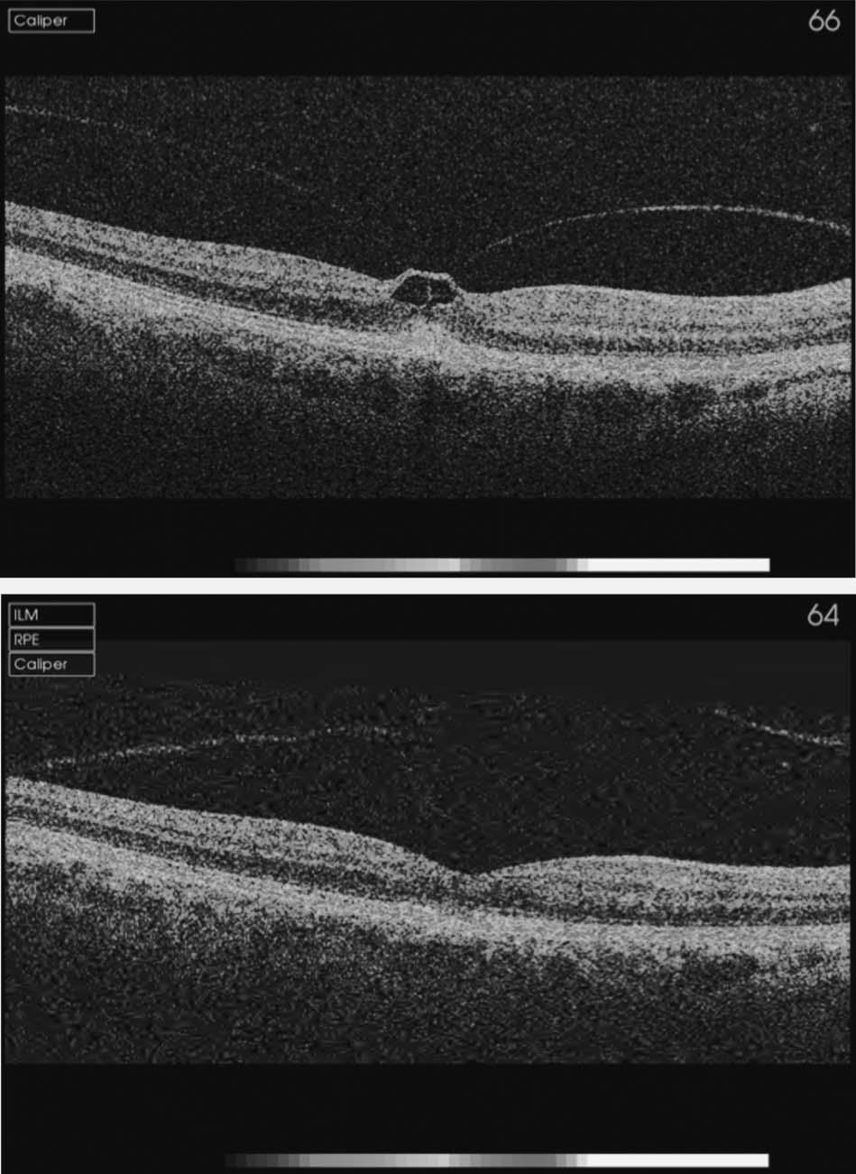 2050 RETINA, THE JOURNAL OF RETINAL AND VITREOUS DISEASES 2012 VOLUME 32 NUMBER 10 Fig. 4. Patient 4. A. Optical coherence tomography of the right eye causing tractional cystoid foveal thickening. B.