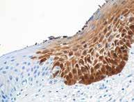 A B Panel A Magnification 20X Panel B Magnification 40X A diffuse staining pattern is sometimes also referred to as a confluent staining, band staining, or block staining, where typically the