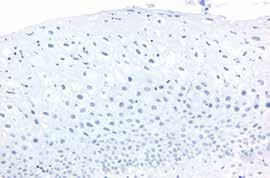 p16 Negative: A test result is rated negative if a p16 stained slide shows either a negative staining reaction in the