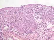 mucosa and absence of staining in adjacent benign glandular cells.