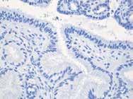 benign mucinous columnar cells, including those in areas of microglandular hyperplasia (Fig 5-4), are consistently negative for p16, benign non-mucinous/secretory cells, tubal metaplasia,