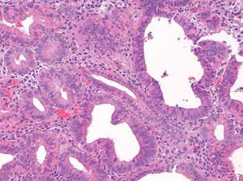 HISTOLOGY A B Fig. 5-6 Tubal metaplasia with focal staining for p16.