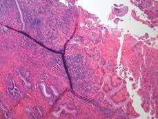 A C CASE 5: Inflammatory atypia versus CIN The mucosa shows dense acute and chronic inflammation with disordered maturation and