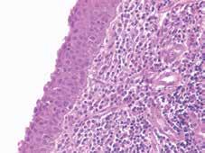 A C CASE 10: Reserve cell hyperplasia versus CIN The mucosa is composed