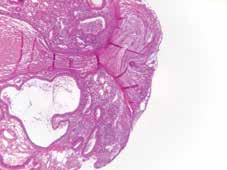 A C CASE 14: CIN 2/3, small lesion Note the complex architectural pattern, including crowded benign endocervical glands, and minute foci of metaplastic squamous cells, in a background of acute and