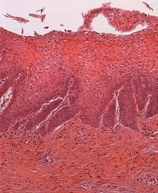 Vaginal mucosa in the basal condition. It is possible to see a thinner epithelium and the presence of papillae.