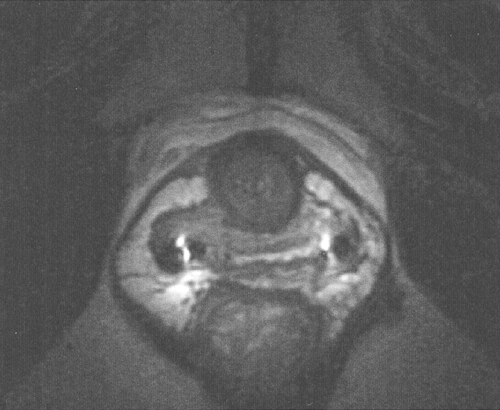 C, Axial MR image obtained at approximately 50th percentile of urethra shows normal pubourethral ligament connecting urethra to arcus tendineus fasciae pelvis and caudal portion of periurethral