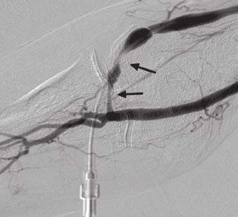 Shenoy and Darcy ly, a combination of narrow lumen and calcification in the artery is associated with poor maturation of the VF.
