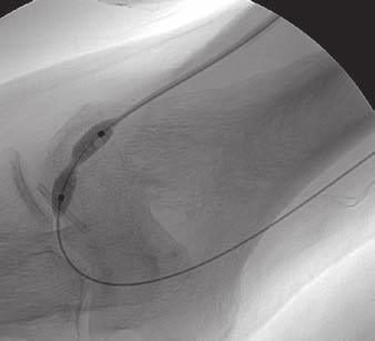 olor Doppler is useful to establish the patency of the artery; however, its reliability to evaluate subtle stenosis in this low-flow setting is limited.