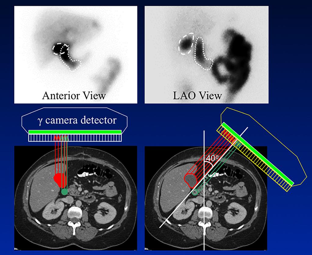 SA-CME APPLIED HEPATOBILIARY SCINTIGRAPHY IN CHRONIC GALLBLADDER DISEASES FIGURE 1. The left upper image was taken in anterior projection at the end of the 60 min of the first hour dynamic phase.