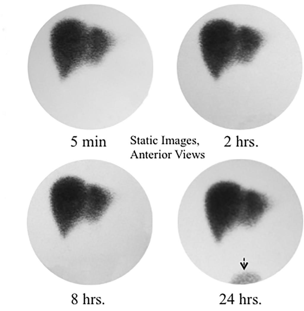 APPLIED HEPATOBILIARY SCINTIGRAPHY IN CHRONIC GALLBLADDER DISEASES SA-CME A B FIGURE 2.