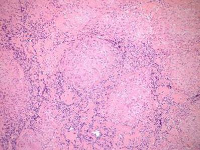 18 F-FDG PET in Cardiac Sarcoidosis Sarcoidosis Systemic disease of unknown cause Pulmonary> skin > eye > bone Cardiac involvement recognized in only a small % of