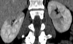 52 yo otherwise healthy, athletic woman, who developed acute onset of bilateral flank pain,