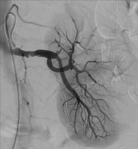 pole left renal artery