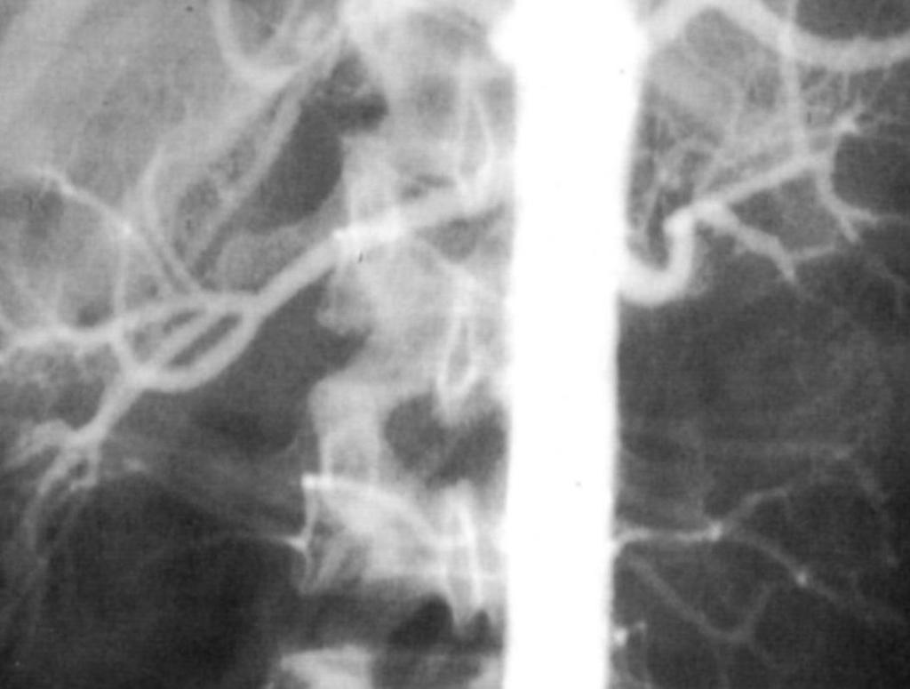 FMD Renal Artery Stenosis Natural History 18 yo