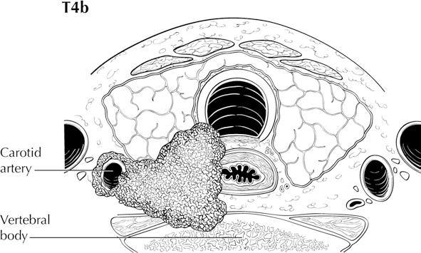 tumor T4b Gross extrathyroidal extension invading pre- vertebral