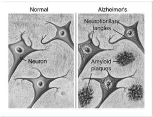 Auguste Deter s Autopsy Brain was significant for numerous abnormal findings: Amyloid plaques Neurofibrillary tangles Findings presented at a conference November 3