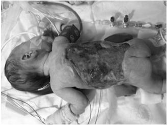 Case study 6 week old male who presented at 8 days old with fever, emesis, erythema to his back Rapidly decompensated requiring: Intubation Pressors ECMO CVVHD Case study