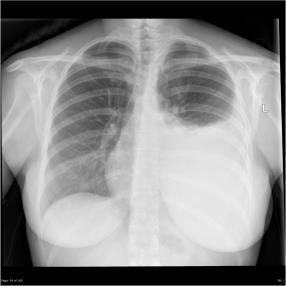 of pulmonary vessels Kerley B lines