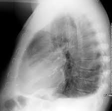 appearance Cardiomegaly?
