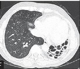 CT without contrast Pulmonary nodules Follow-up consolidations, ground glass opacities, etc