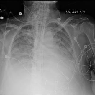 Summary Use the same method for interpreting all of your films CXR ABCDE or inside-out CT chest: Look at lung and mediastinal windows to assess both parenchyma and adenopathy, respectively Determine
