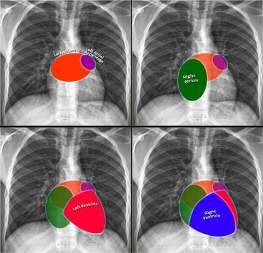 Right diaphragm (red arrow): Can be