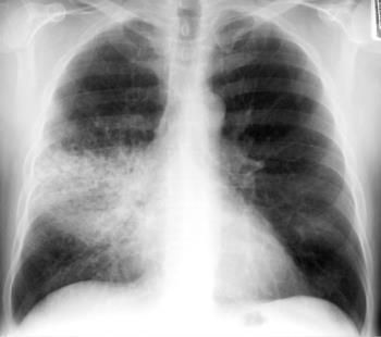 Silhouette Sign Loss of silhouette or lung/tissue border due to change in density of the typically air-filled lung 25 Pick an Approach: ABCDE(FGH) A Airway (Trachea midline?