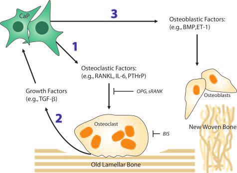 cells and can promote osteoclastogenesis. Finally, MMPs, which are secreted by prostate cancer cells, promote osteolysis primarily through degradation of the nonmineralized bone matrix.